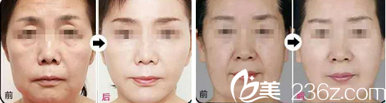 整形除皺案例 整形除皺案例