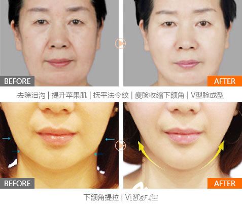 寧波薇琳鄭永強(qiáng)面部線雕案例 寧波薇琳鄭永強(qiáng)面部線雕案例