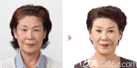 竹內(nèi)式面部提升術(shù)