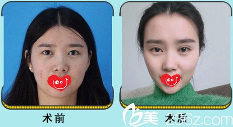 京美瘦臉案例