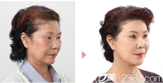 竹內(nèi)式面部拉皮 W-SMAS