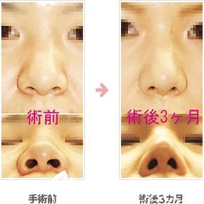 鼻尖縮小術(shù)
