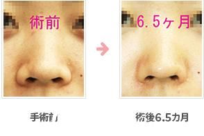 鼻翼縮小術(shù)