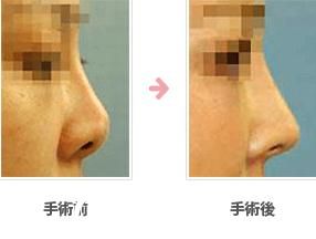 鼻中隔延長
