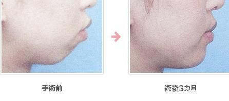 下巴植入假體