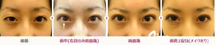 不腫的埋設(shè)法雙眼皮 不腫的埋設(shè)法雙眼皮