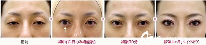 不開刀治療眼瞼下垂 不開刀治療眼瞼下垂
