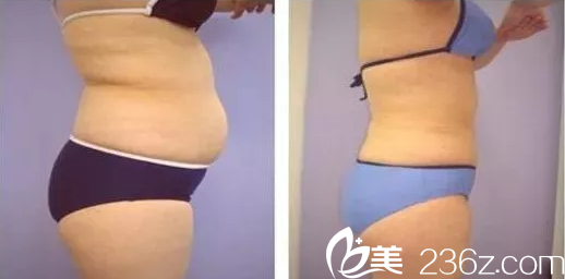 醫(yī)療美容李斌醫(yī)生腰腹吸脂案例 醫(yī)療美容李斌醫(yī)生腰腹吸脂案例