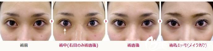 埋設(shè)法雙眼皮 埋設(shè)法雙眼皮