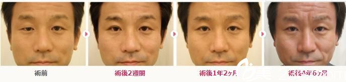 眼瞼下垂修正 眼瞼下垂修正