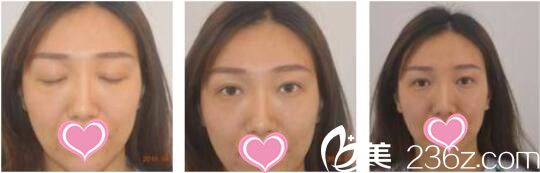 韓國天鵝swan整形醫(yī)院黃成浩眼修復真人案例術前照 韓國天鵝swan整形醫(yī)院黃成浩眼修復真人案例術前照