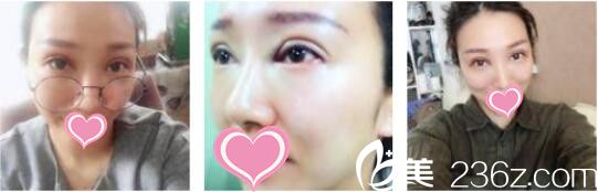 韓國天鵝swan整形醫(yī)院黃成浩眼修復真人案例術后第五天 韓國天鵝swan整形醫(yī)院黃成浩眼修復真人案例術后第五天