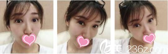 雙眼皮整失敗了怎么辦？看我找韓國天鵝swan整形黃成浩做了眼修復術后效果圖