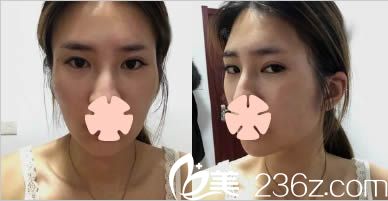 昆明夢想整形面部填充術前照 昆明夢想整形面部填充術前照