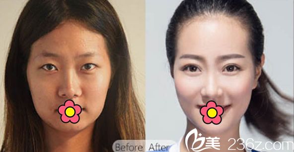 華美楊艷切開雙眼皮+鼻綜合隆鼻效果案例