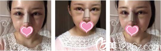 韓國天鵝swan整形醫(yī)院黃成浩鼻綜合+自體脂肪面部填充真人案例術(shù)后第二天 韓國天鵝swan整形醫(yī)院黃成浩鼻綜合+自體脂肪面部填充真人案例術(shù)后第二天