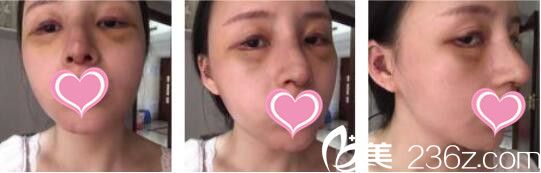 韓國天鵝swan整形醫(yī)院黃成浩鼻綜合+自體脂肪面部填充真人案例術(shù)后第七天 韓國天鵝swan整形醫(yī)院黃成浩鼻綜合+自體脂肪面部填充真人案例術(shù)后第七天