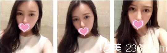 我在韓國天鵝swan整形找黃成浩做鼻綜合+自體脂肪面部填充，一個月的時間變身精致女神