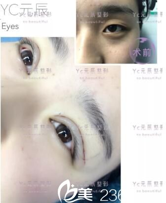 元生態(tài)雙眼皮+開眼角術(shù)前術(shù)后即刻效果對比 元生態(tài)雙眼皮+開眼角術(shù)前術(shù)后即刻效果對比