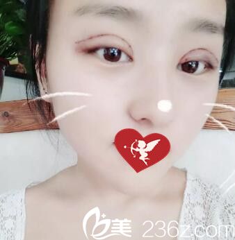 做元生態(tài)雙眼皮+開眼角術(shù)后第三天效果 做元生態(tài)雙眼皮+開眼角術(shù)后第三天效果