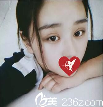 雙眼皮+開眼角術(shù)后10天恢復(fù)程度效果 雙眼皮+開眼角術(shù)后10天恢復(fù)程度效果