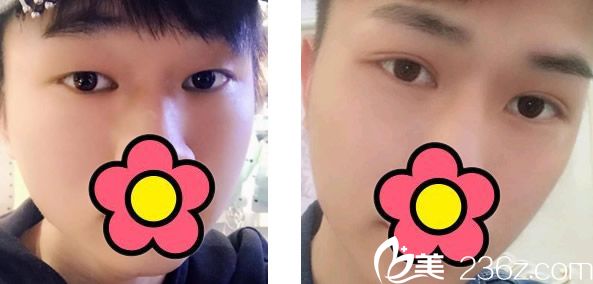 華美王金紅全切雙眼皮效果案例