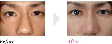 鼻骨縮小術(shù) 鼻骨縮小術(shù)