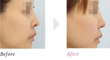 鼻孔上緣下降術(shù) 鼻孔上緣下降術(shù)