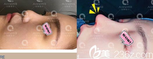 合肥安妮薇爾李繼銀肋軟骨鼻綜合案例