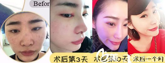 田軍達拉斯隆鼻術后恢復過程圖