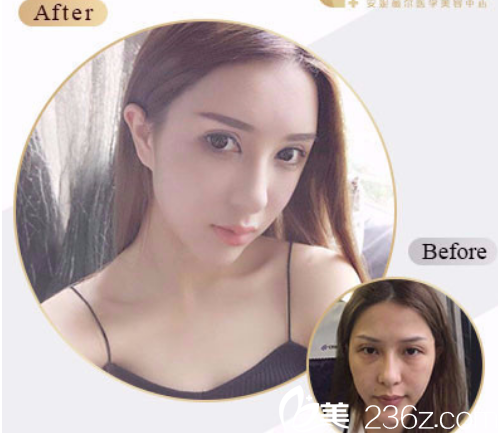 程林軍自體脂肪全臉填充案例