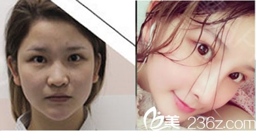 李秋艷玻尿酸除皺填充面部年輕化案例前后效果對比