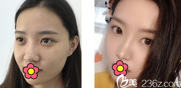 包頭葉子馮守運(yùn)院長(zhǎng)假體+自體軟骨綜合隆鼻前后效果對(duì)比