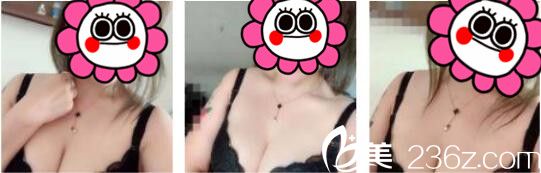 我只是去韓國天鵝swan整形找黃成浩做了自體脂肪隆胸，沒想到脂肪留存的很好手感也特別柔軟