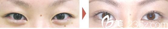 雙眼皮手術