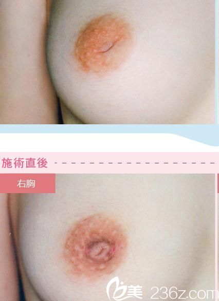 乳頭修復(fù)