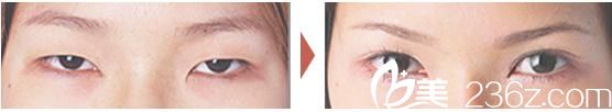 眼瞼下垂修正