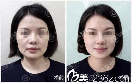 楊定宇博士玻尿酸隆鼻、填淚溝、法令紋真人前后效果對(duì)比