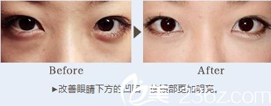 對鼻子和眼睛下方玻尿酸注射