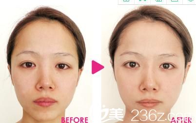 Dr.衣理式TrueLift立提注射