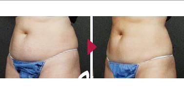 先端機(jī)器瘦身術(shù)