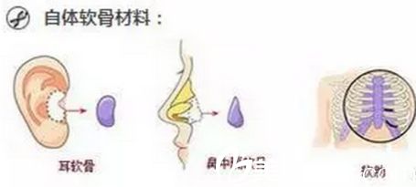 自體軟骨的材料來源