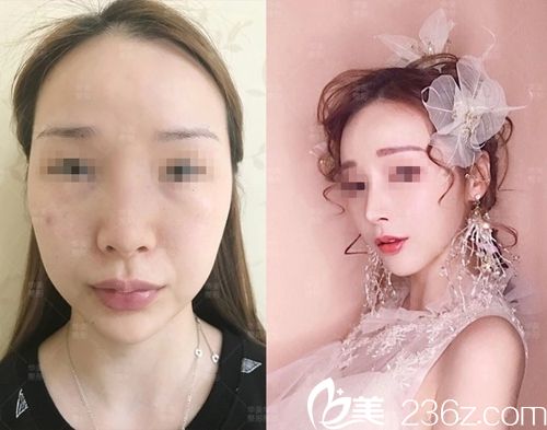 付國友隆鼻真人案例