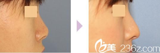 鼻中隔延長 鼻中隔延長