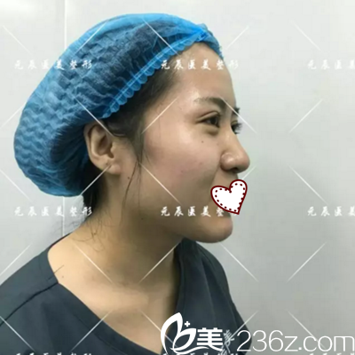 做4D記憶鼻綜合術(shù)前照片 做4D記憶鼻綜合術(shù)前照片