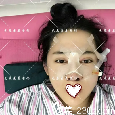 4D記憶鼻綜合術(shù)后天情況 4D記憶鼻綜合術(shù)后天情況