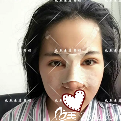 4D記憶鼻綜合術(shù)后第三天拆引流管后 4D記憶鼻綜合術(shù)后第三天拆引流管后