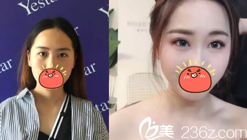 嘉興藝星割雙眼皮案例對比圖