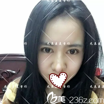 4D鼻綜合術(shù)后一周拆線 4D鼻綜合術(shù)后一周拆線