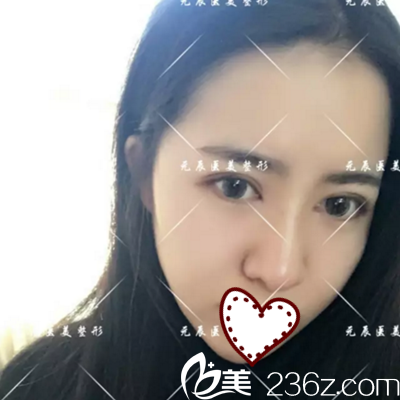 分享本溪元辰醫(yī)療美容譚臻田院長(zhǎng)為我做的4D記憶鼻綜合術(shù)后15天恢復(fù)效果圖！